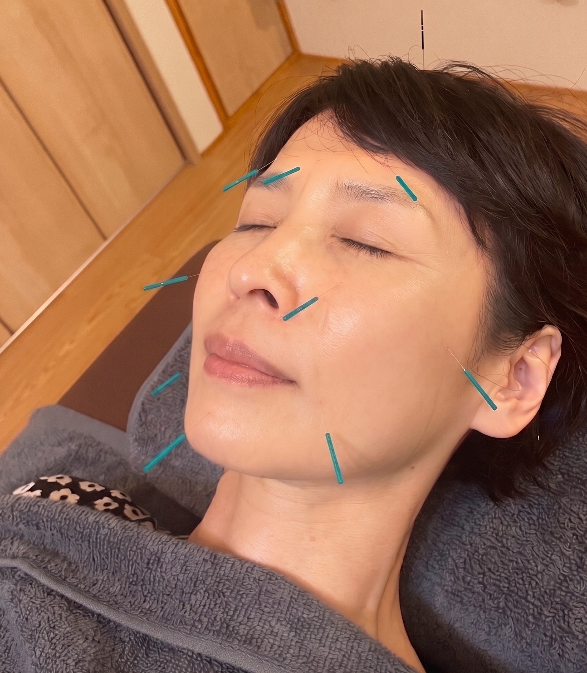 美容鍼